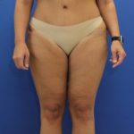 after Thigh Lift front angle view Case 1132