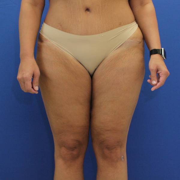 after Thigh Lift front angle view Case 1132