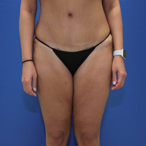 before Thigh Lift front angle view Case 1132