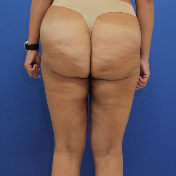 after Thigh Lift front angle view Case 1132