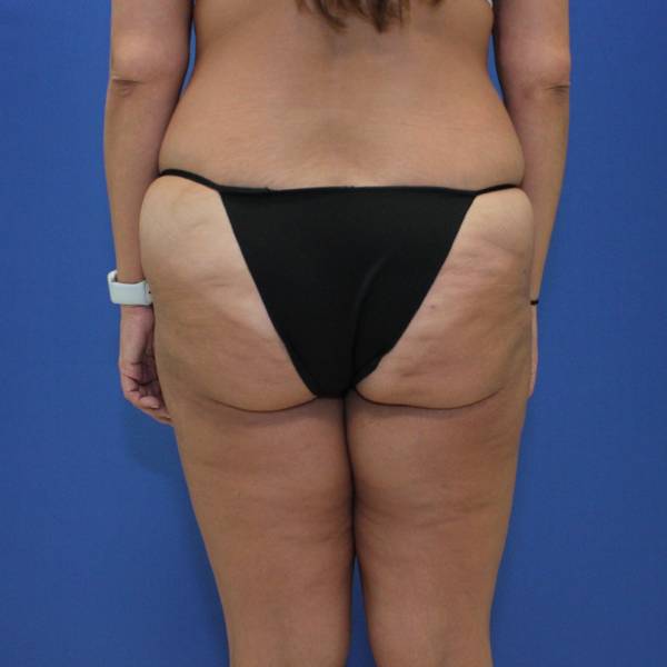 before Thigh Lift back angle view Case 1132