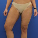 after Thigh Lift front angle view Case 1132