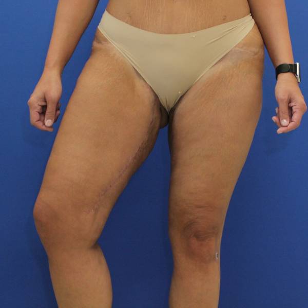 after Thigh Lift front angle view Case 1132