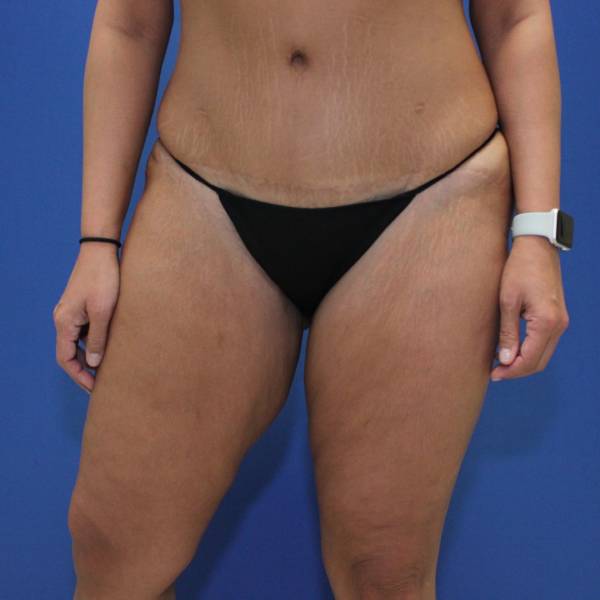 before Thigh Lift front angle view Case 1132