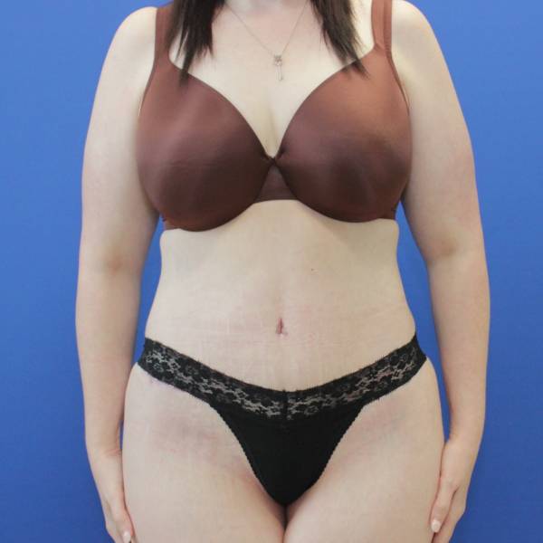 after Tummy Tuck female patient front angle view Case 1253