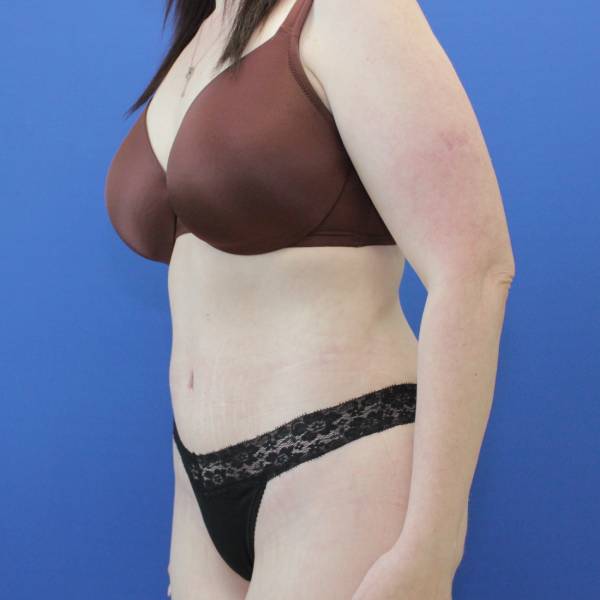 after Tummy Tuck female patient left angle view Case 1253