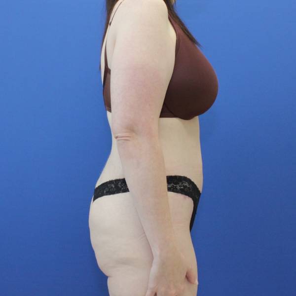 after Tummy Tuck female patient side angle view Case 1253