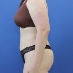 after Tummy Tuck female patient side angle view Case 1253