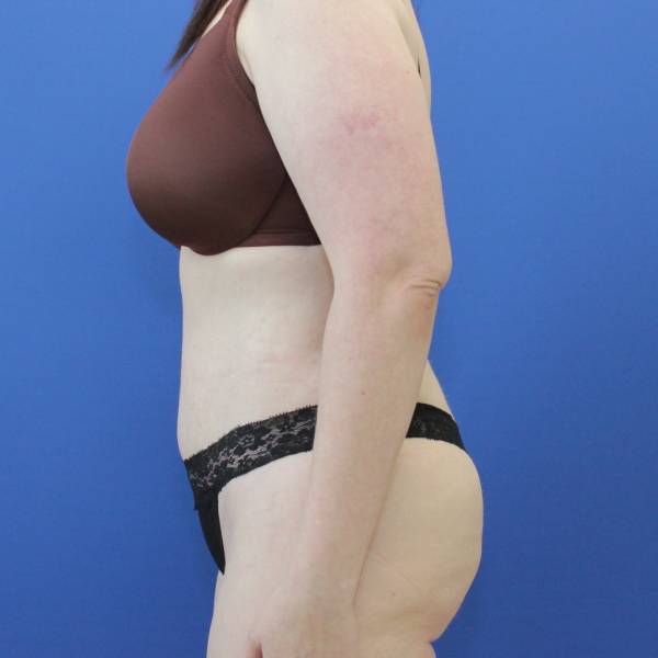 after Tummy Tuck female patient side angle view Case 1253