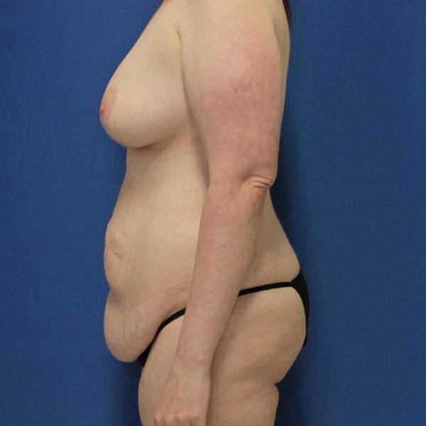 before Tummy Tuck female patient side angle view Case 1253