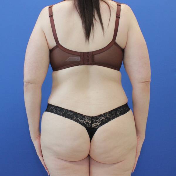 after Tummy Tuck female patient back angle view Case 1253