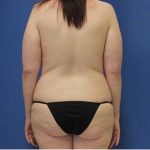 before Tummy Tuck female patient back angle view Case 1253