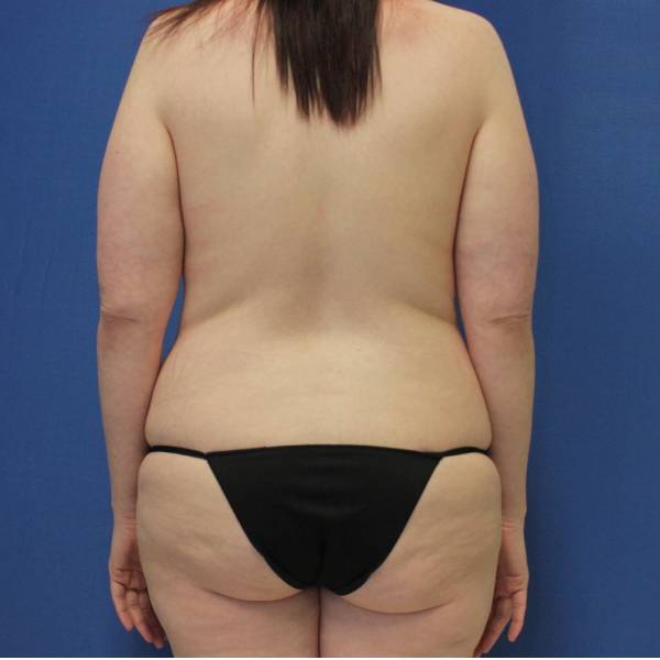 before Tummy Tuck female patient back angle view Case 1253