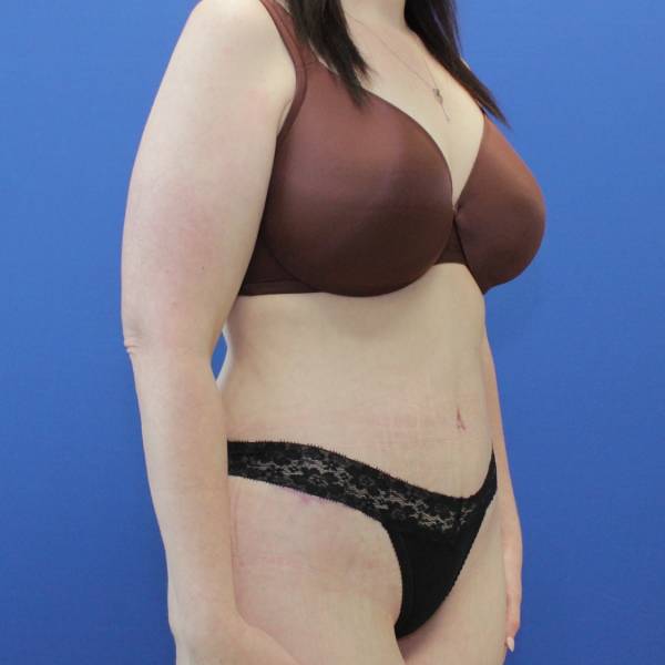 after Tummy Tuck female patient right angle view Case 1253