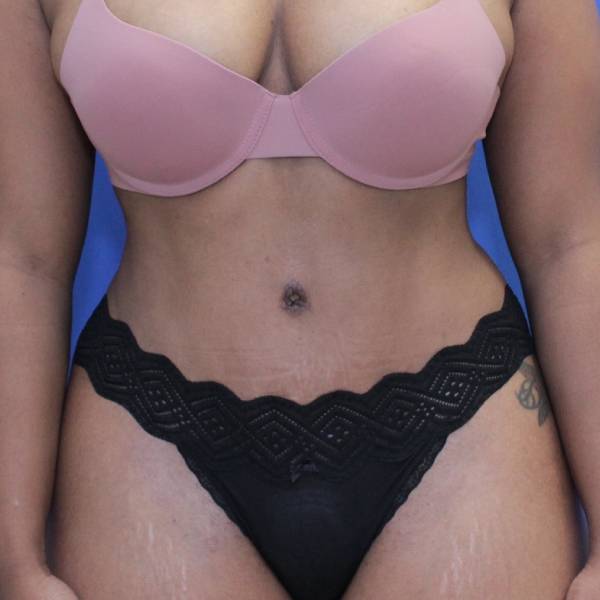 after Tummy Tuck female patient front angle view Case 1350