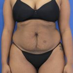 before Tummy Tuck female patient front angle view Case 1350