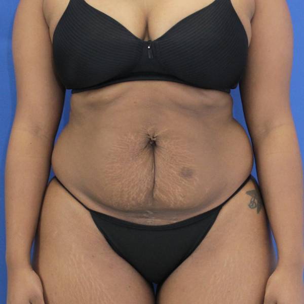 before Tummy Tuck female patient front angle view Case 1350