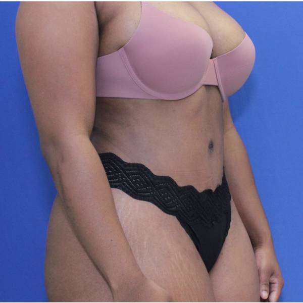 after Tummy Tuck female patient right angle view Case 1350