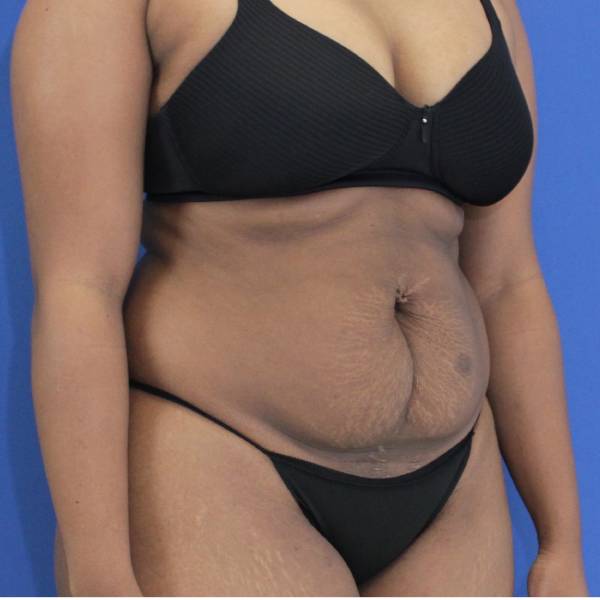 before Tummy Tuck female patient right angle view Case 1350