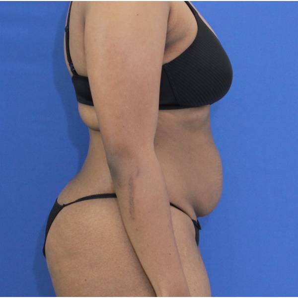 before Tummy Tuck female patient side angle view Case 1350