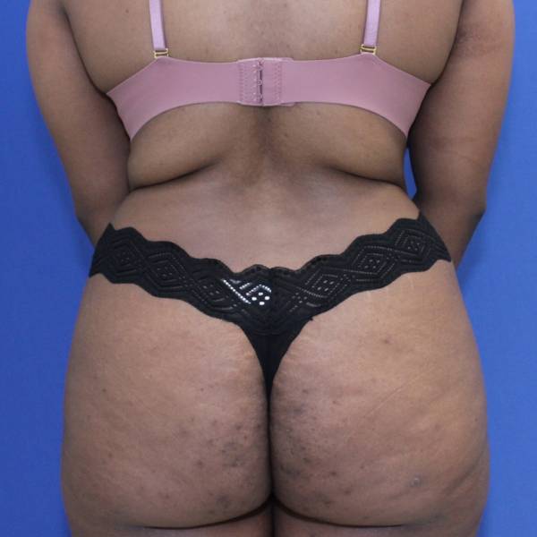 after Tummy Tuck female patient back angle view Case 1350