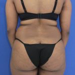 before Tummy Tuck female patient back angle view Case 1350