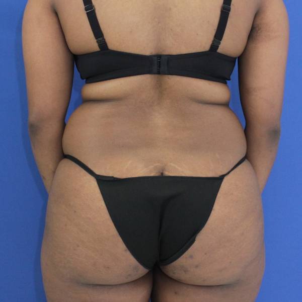 before Tummy Tuck female patient back angle view Case 1350