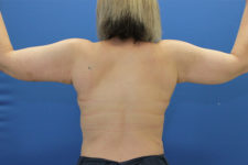 after arm lift female patient back view case 1714