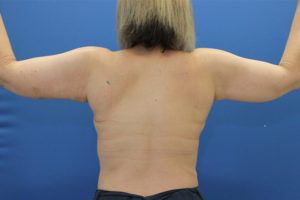after arm lift female patient back view case 1714