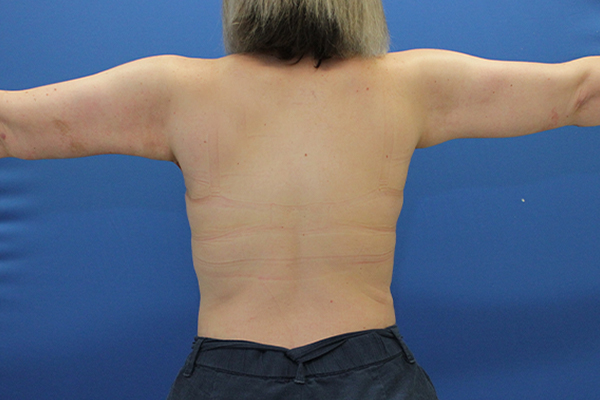after arm lift female patient back view arms straight case 1714
