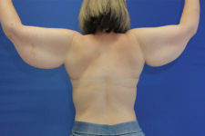 before arm lift female patient back view case 1714