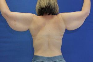 before arm lift female patient back view case 1714