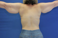 arm lift female patient back arms straight view case 1714