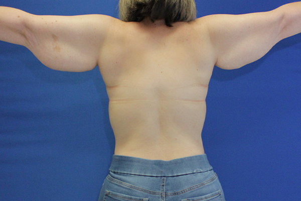 arm lift female patient back arms straight view case 1714