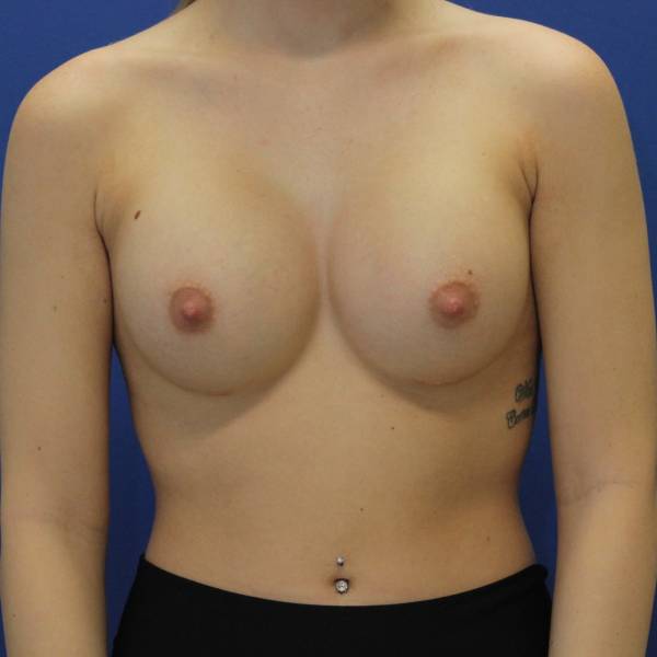after breast augmentation front female case 1972
