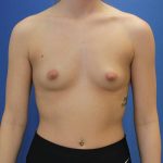 before breast augmentation front female case 1972