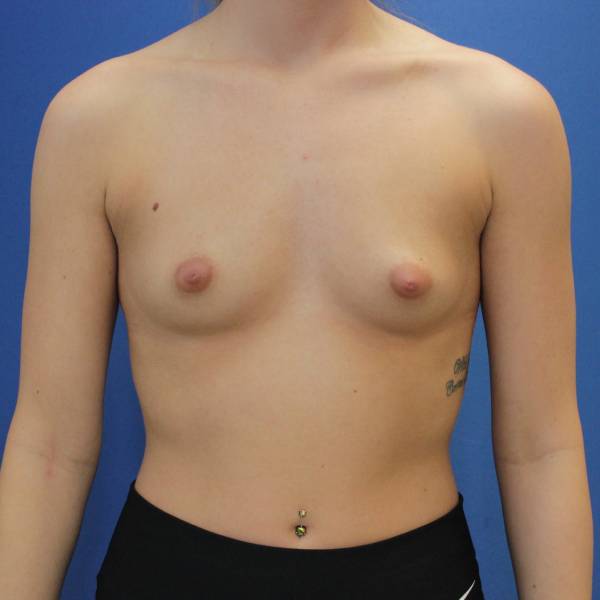before breast augmentation front female case 1972