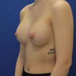 after breast augmentation left angle female case 1972