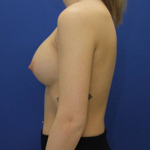 after breast augmentation left side female case 1972