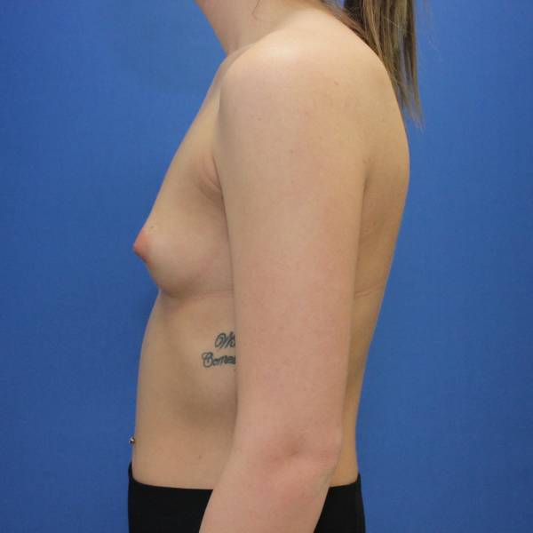 before breast augmentation left side female case 1972