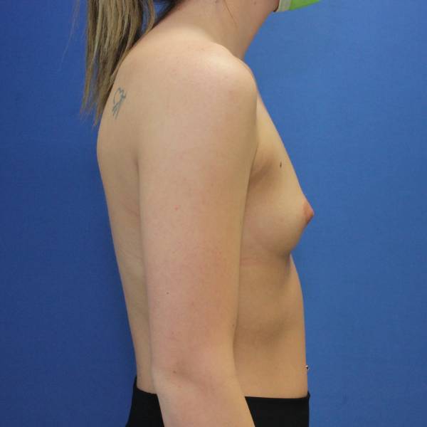 before breast augmentation right side female case 1972