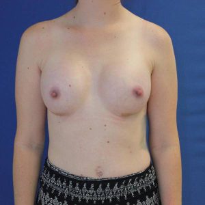 after breast augmentation front female case 1971