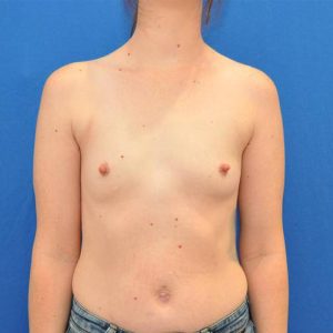 before breast augmentation front female case 1971