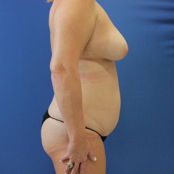 before mommy makeover right side view case 2067