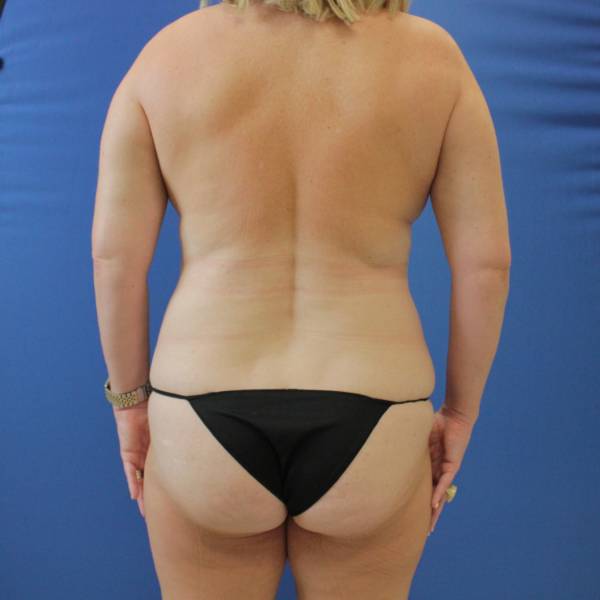 before mommy makeover back view case 2067