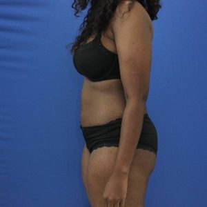 after tummy tuck left side view female patient case 1871