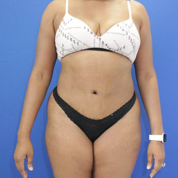 after tummy tuck front view female patient case 1893