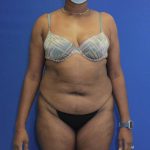 before tummy tuck front view female patient case 1893