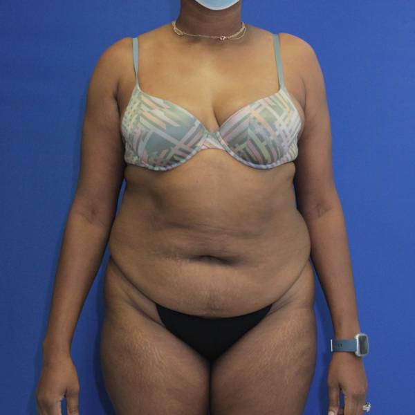 before tummy tuck front view female patient case 1893