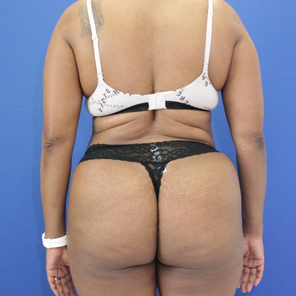 after tummy tuck back view female patient case 1893